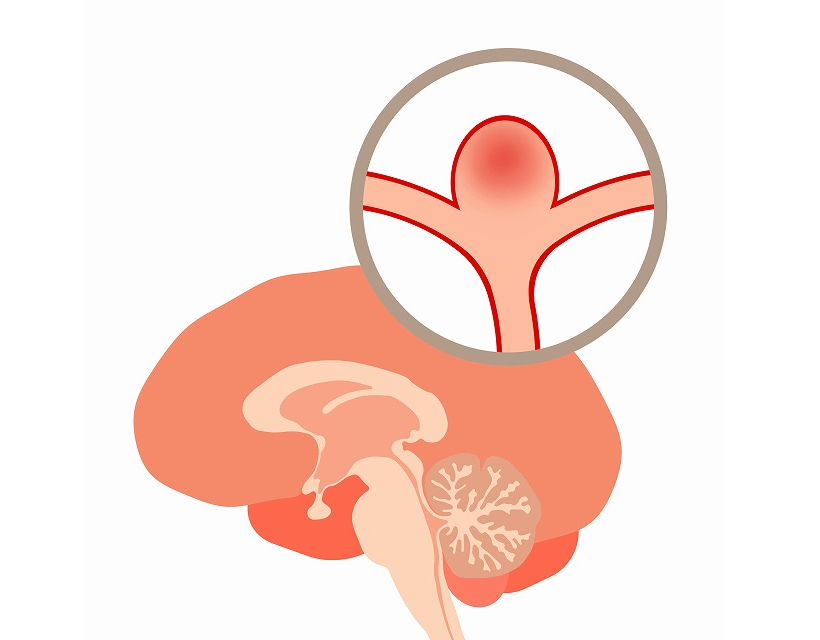 脳動脈瘤とは