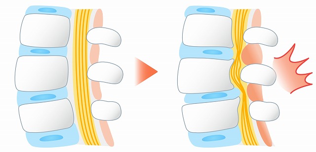 脊柱管狭窄症とは